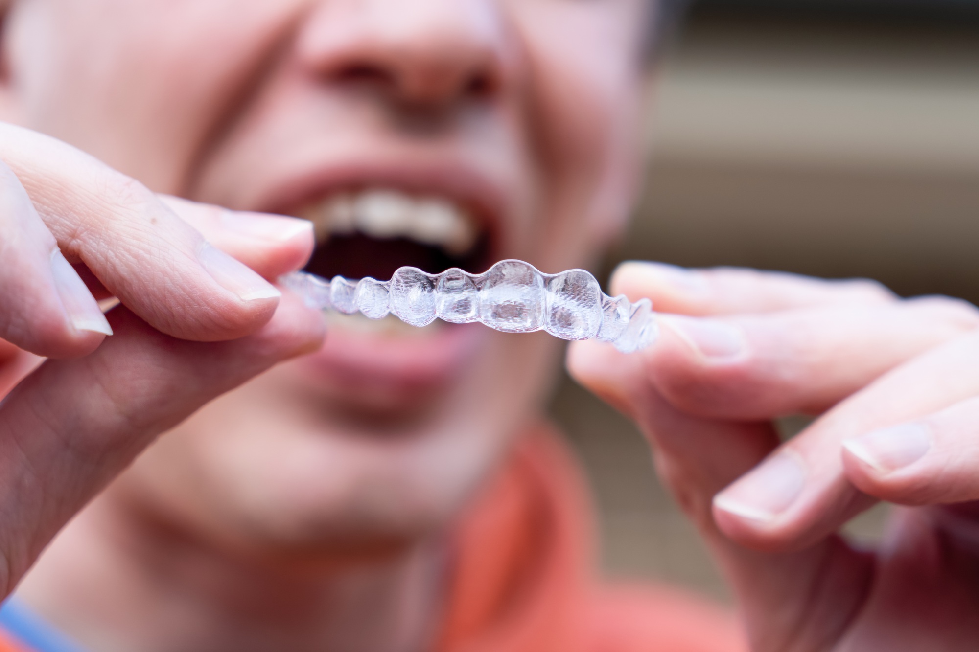 Man holds put on invisible braces. Invisalign plastic removable braces